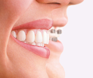 invisalign03